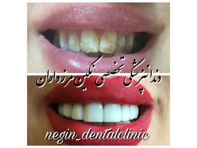 زیبایی و کاشت دندان-دندانپزشکی تخصصی  در مرزداران ،  دندانپزشکی تخصصی نگین مرزداران