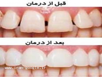ایمپلنت و زیبایی دندان-جراح دهان و دندان 