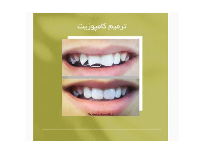 انواع کامپوزیت ساختمان- جراح و دندانپزشک زیبایی در شیراز