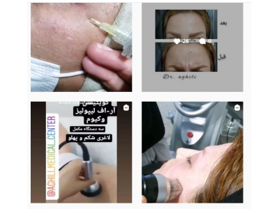 زاویه‌سازی صورت-کلینیک زیبایی و لیزر دکتر مجتبی عقیلی در کردکوی