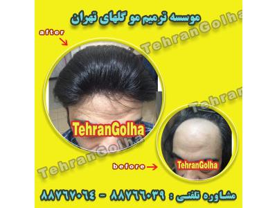 درمان ریزش مو در تهران-های فیکس آلمان برند برتر ترمیم مو