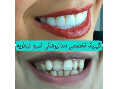 ایمپلنت و زیبایی دندان-دندانپزشکی در منطقه یک تهران ،  کلینیک دندانپزشکی نسیم قیطریه