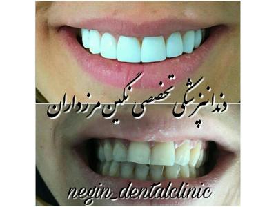 اصلاح طرح لبخند-دندانپزشکی تخصصی  در مرزداران ،  دندانپزشکی تخصصی نگین مرزداران