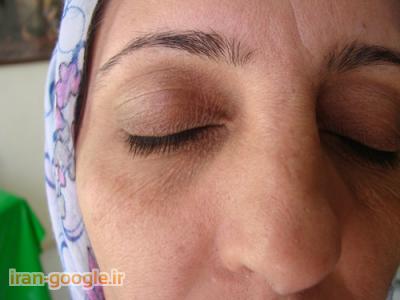 معجزه-زالو درمانی در شیراز