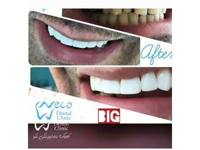 دندان خود را سفید کنید-کلینیک دندانپزشکی و دندانسازی  نکو  در محدوده اشرفی اصفهانی