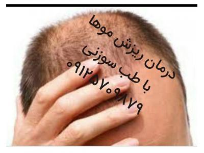 سیم کشی ها ن-درمان ریزش مو با طب سوزنی