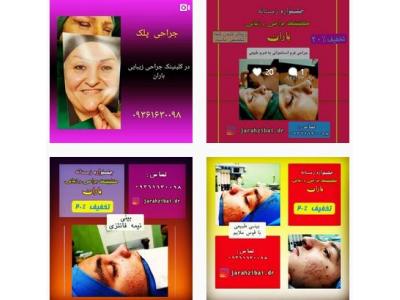 درمان افتادگی پلک- دکتر مهدی عرفانی متخصص جراح زیبایی در تهران