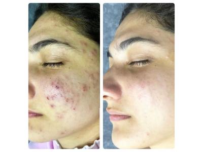 کلینیک زیبایی در تهران-فیشیال تخصصی پوستهای چرب، خشک و مختلط