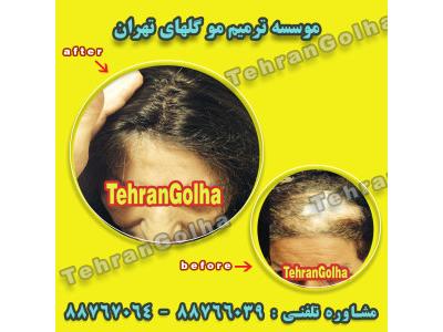 درمان ریزش مو در تهران-های فیکس آلمان برند برتر ترمیم مو
