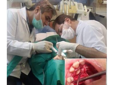 لمینت مات-بهترین مطب دندانپزشکی در سعادت آباد 