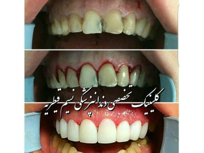 پروتز زیبایی-دندانپزشکی در منطقه یک تهران ،  کلینیک دندانپزشکی نسیم قیطریه