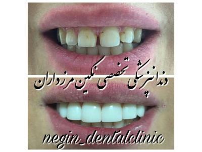 دندان سفید-دندانپزشکی تخصصی  در مرزداران ،  دندانپزشکی تخصصی نگین مرزداران