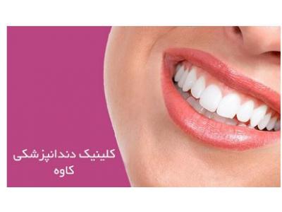 عصب‌کشی دندان-کلینیک تخصصی دندانپزشکی در قیطریه ،  ایمپلنت و کامپوزیت ونیر
