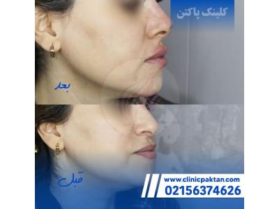 تزریق ژل بوتاکس-بهترین  و مجهزترین کلینیک لیزر و زیبایی در اسلامشهر 