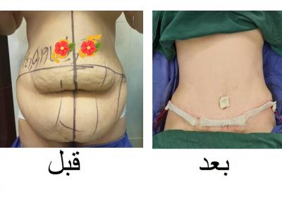 دید-دکتر محمد گنجه جراح چاقی و پلاستیک ، جراحی کولورکتال و لاپاراسکوپی و بوتاکس معده