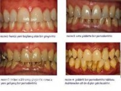 تولید کننده کلسیم- تاثیر آب یونیزه قلیایی بر پوسیدگی دندان