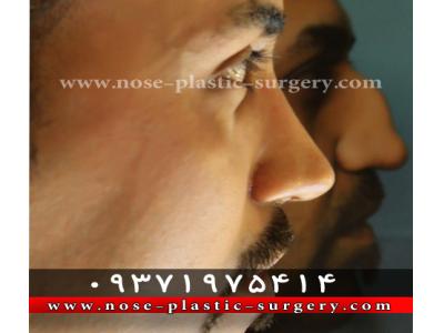 درمان گودی زیر چشم-کلینیک جراحی بینی دکتر علی شهابی