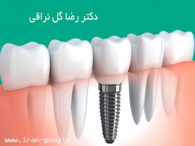 عصب‌کشی دندان-متخصص ایمپلنت