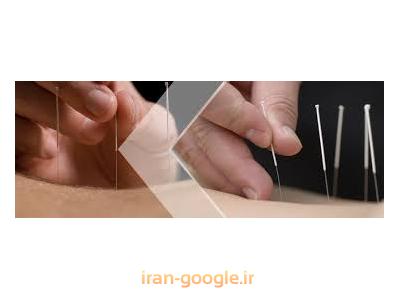 زخم معده-مرکز تخصصی طب سوزنی  فرمانیه 