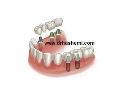 HSE-مرکز کاشت دندان و زیبایی