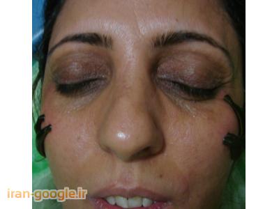جوش های صورت-زالو درمانی در شیراز