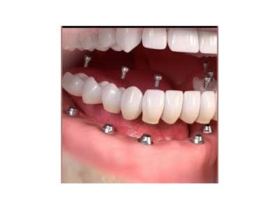جراحی های زیبایی-کلینیک دندانپزشکی دکتر محمدرضا معزز جراح ، دندانپزشک متخصص ایمپلنت در تهرانپارس