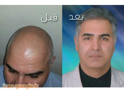 انجمن پزشکی آمریکا-دکتر علی فولادیان مرکز کاشت موی طبیعی در تهران 